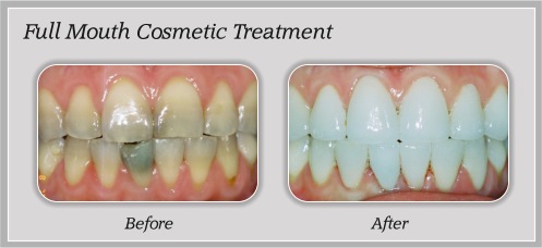 stetson village family dentistry glendale az patient education smile gallery full mouth cosmetic treatment