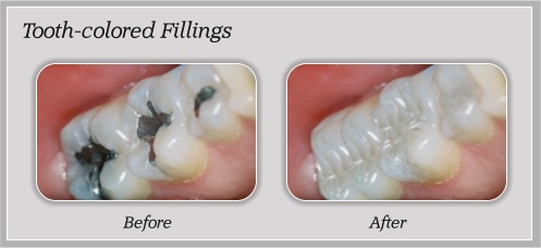 stetson village family dentistry glendale az patient education smile gallery tooth colored fillings