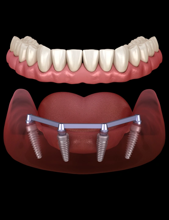 All-on-4 dental implant restoration replacing a full arch of missing teeth