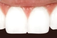 Smile restored with cosmetic dental bonding for a natural appearance