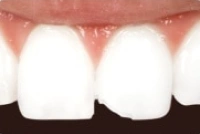 Chipped front tooth before cosmetic dental bonding treatment