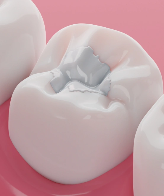 Dental filling restoring a cavity and natural tooth appearance