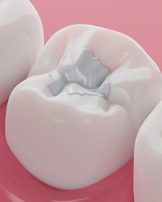 Tooth-colored dental filling restoring a cavity and natural tooth appearance