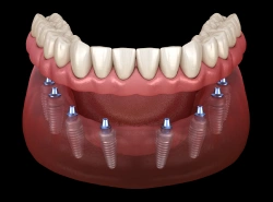 Full-arch dental implant solution restoring an entire row of teeth