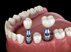 Multiple dental implants used to replace several missing teeth