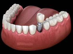 Single dental implant restoration replacing one missing tooth
