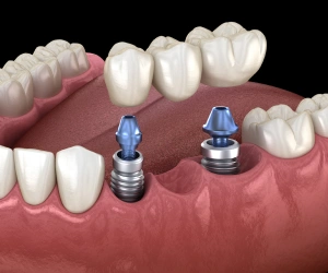 Implant-supported dental bridge replacing multiple missing teeth