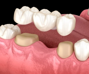 Traditional dental bridge restoring gaps caused by missing teeth