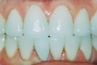 Full mouth cosmetic dentistry smile makeover after treatment