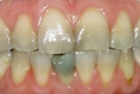 Full mouth cosmetic dentistry smile before treatment