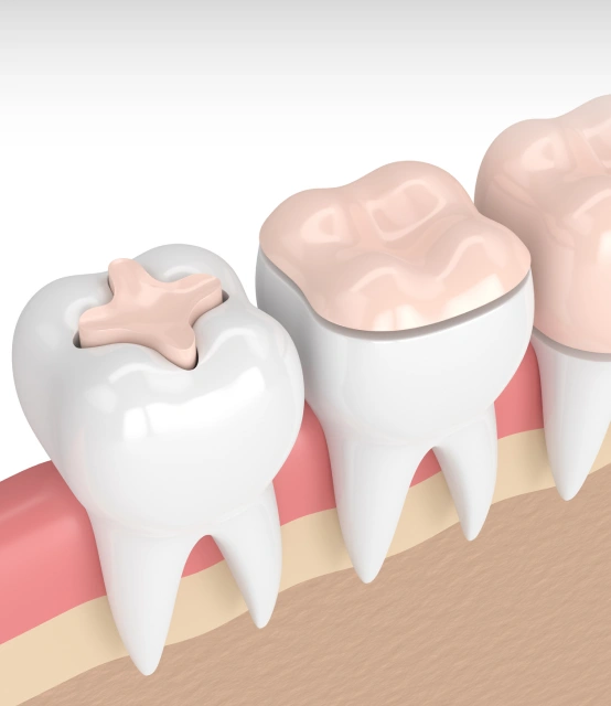 Custom dental inlays and onlays providing durable tooth restoration