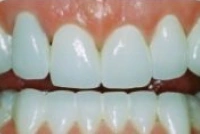 Smile restored with custom porcelain crowns after treatment