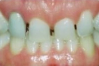 Teeth before porcelain crown restoration treatment