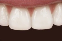 Smile after treatment to correct gaps and spacing between teeth