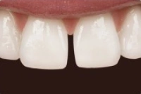 Teeth with visible spacing issues before cosmetic treatment