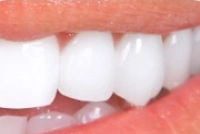 Bright smile after professional teeth whitening treatment