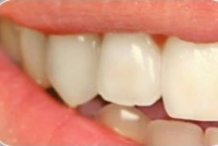 Teeth before professional whitening treatment