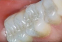 Tooth-colored filling seamlessly restoring a damaged tooth