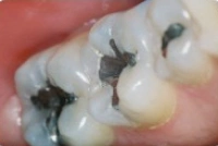 Tooth with old dental filling before restoration with a tooth-colored filling
