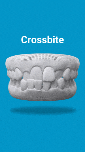 Invisalign treatment for crossbite correction