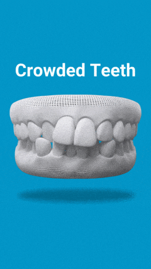 Invisalign treatment for crowded teeth