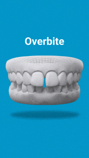 Invisalign treatment for overbite correction