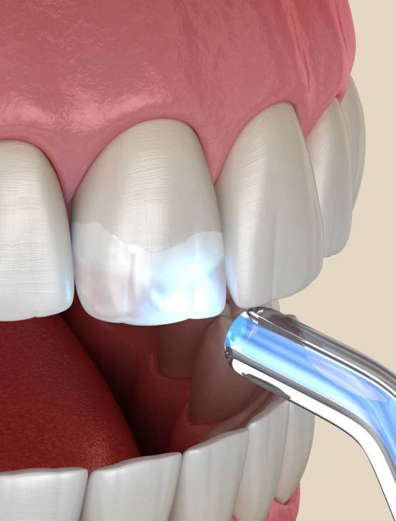 3D illustration of a dental bonding procedure, with a curing light hardening composite resin on a front tooth.